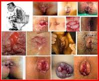 Gambar Obat Herbal Wasir Dalam Ambeclear Ampuh Tanpa Operasi