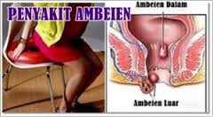 Foto Pengobatan Alternatif Wasir Dalam Kronis dengan Ambeclear