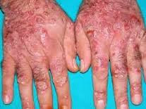 Foto Salep Obat Gatel Alami Dan Manjur Sembuh Dengan Permanen