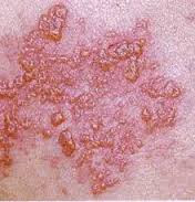 Gambar Jenis Obat Gatal Gatal Eksim Basah Paling Mujarab Di Apotik