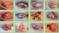 Foto Obat cina untuk wasir berdarah tanpa operasi