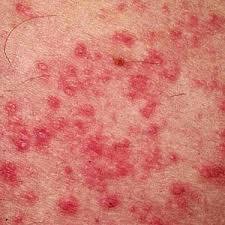 Gambar Nama Obat Gatal Gatal Di Apotik Ampuh