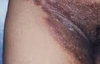 Gambar Obat Krim Gatal Pada Kulit Yang Ampuh & Manjur Di Apotik