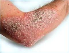 Foto Obat Kulit Gatal Yang Ampuh Untuk Menyembuhkan Gatel Karena Eksim Kering Di Selangkangan