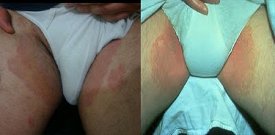 Gambar Salep gatal pada seluruh badan yang ampuh dari bahan alami