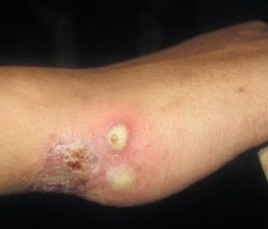 Gambar Obat Gatal Yang Ampuh Untuk Kulit kemaluan Di Apotik