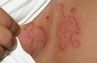 Gambar Obat jamur eksim kulit selangkangan di apotik