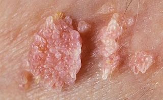 Gambar Gejala kutil kelamin jenis genital warts, apakah bahaya?
