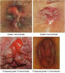 Gambar Pengobatan Sinshe Wasir De Nature Indonesia Tanpa Efek Samping