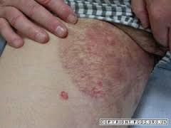 Foto Salep GATEL Atau Gatal Di Selangkangan Pria Dan Wanita Ampuh