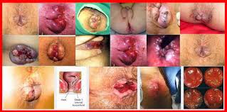 Foto Kenapa Bab Berdarah Tanpa Rasa Sakit, Apa Penyebabnya