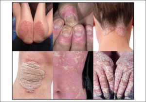 Gambar Cara Mengobati Gatal Kulit Karena Jamur Di Lengan Siku