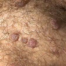 Foto Cara Pengobatan Ampuh Untuk Bintik – bintik Di Area Testis