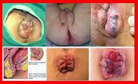 Foto Cara Mengobati Buang Air Besar Keras Dan Bedarah Pada Orang Dewasa