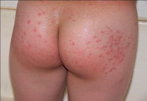 Gambar Gejala gatal di selangkangan wanita karena eksim