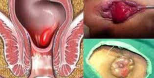 Foto Obat wasir berdarah herbal tanpa operasi di apotik jakarta