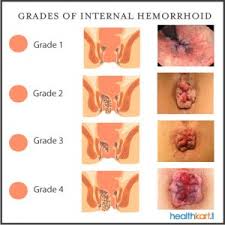Gambar Obat Herbal Wasir Online Terbaik Manjur