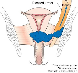 Gambar Obat Kanker Serviks Yang Manjur