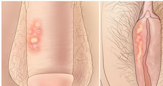 Gambar Obat bibir miss v gatal perih mengelupas karena sipilis