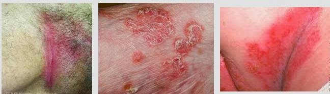 Foto Obat Ampuh Untuk Menyembuhkan Gatal Pada Kulit Yang Mengelupas Dan Kering