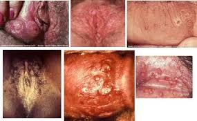 Salep anti radang untuk lecet di kemaluan yang paling ampuh Salep anti radang untuk lecet di kemaluan yang paling ampuh