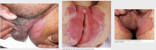 Foto Obat Gatal Parah Karena Penyakit Eksim Kering Pada Kaki Di Apotik Yang Manjur