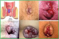 Gambar BAB BERDARAH OBAT NYA AMAN DAN EFEKTIF