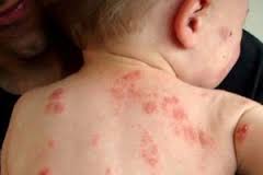 Gambar Jenis Obat Gatal Eksim Basah Di Tubuh