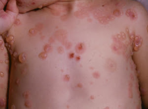 Gambar Obat Alami Gatal Gatal Eksim Basah Paling Manjur