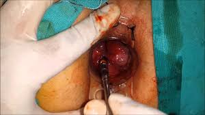 Foto Obat Herbal Wasir Bengkak Ambeclear Paling Ampuh Tanpa Operasi