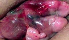 Gambar BAB BERDARAH MINUM OBAT APA YANG MUJARAB