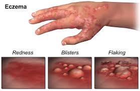 Gambar Jual Obat  Gatal Eksim Basah Herbal Di Apotik