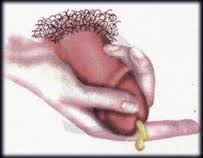 Gambar Obat Mujarab Herbal Keluar Nanah Saat Kencing