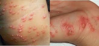 Foto Cara Alami Untuk Mengobati Gatal Karena Penyakit Kulit Di selangkangan Dengan Cepat