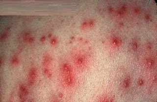 Gambar Gejala, Penyebab Serta : Obat Herpes Untuk Kelamin Paling Ampuh