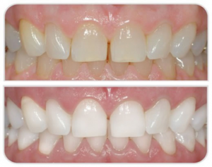 Teeth Whitening Dentist