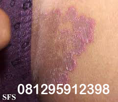 Foto Kenapa Di Selangkangan Timbul Putih Putih Gatal Gejala Penyakit Apa