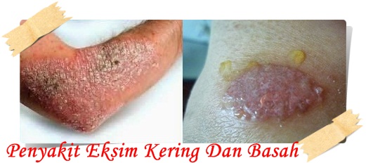 Foto PENGOBATAN TRADISIONAL PENYAKIT GATAL EKSIM BASAK DAN KERING